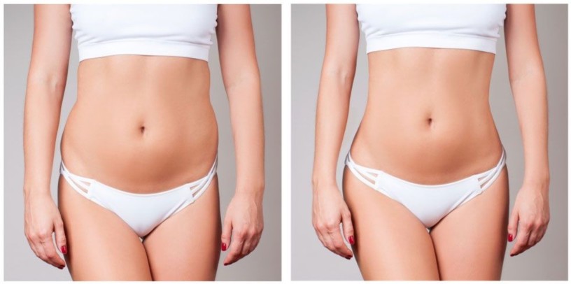 bodytite-sovremennaya-radiocastotnaya-liposakciya-bez-boli-big-0