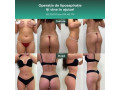 operatie-de-lipoaspiratie-small-0
