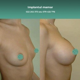 implant-mamar-cea-mai-sanatoasa-metoda-de-marire-a-sanilor-big-0