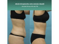 abdominoplastie-solutia-ideala-pentru-kilogramele-in-plus-small-0