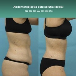 abdominoplastie-solutia-ideala-pentru-kilogramele-in-plus-big-0