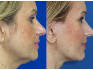 Lifting facial spune adio ridurilor profunde