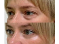 blefaroplastie-inferioara-inlatura-pungile-de-sub-ochi-small-0