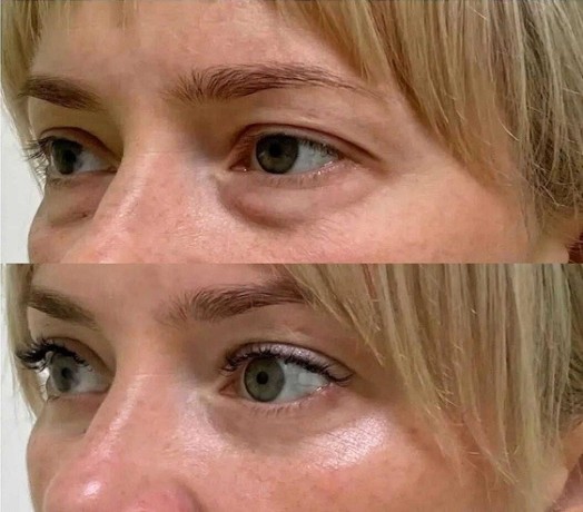 blefaroplastie-inferioara-inlatura-pungile-de-sub-ochi-big-0