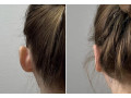 otoplastie-operatie-estetica-la-urechi-small-0