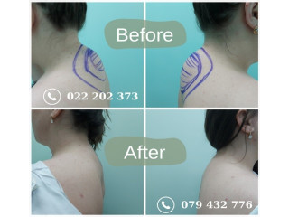 Liposucția zonei cervicale