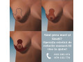 operatie-de-reductie-mamara-small-0